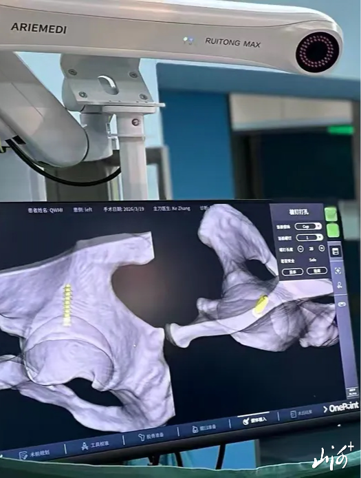全髋关节置换手术